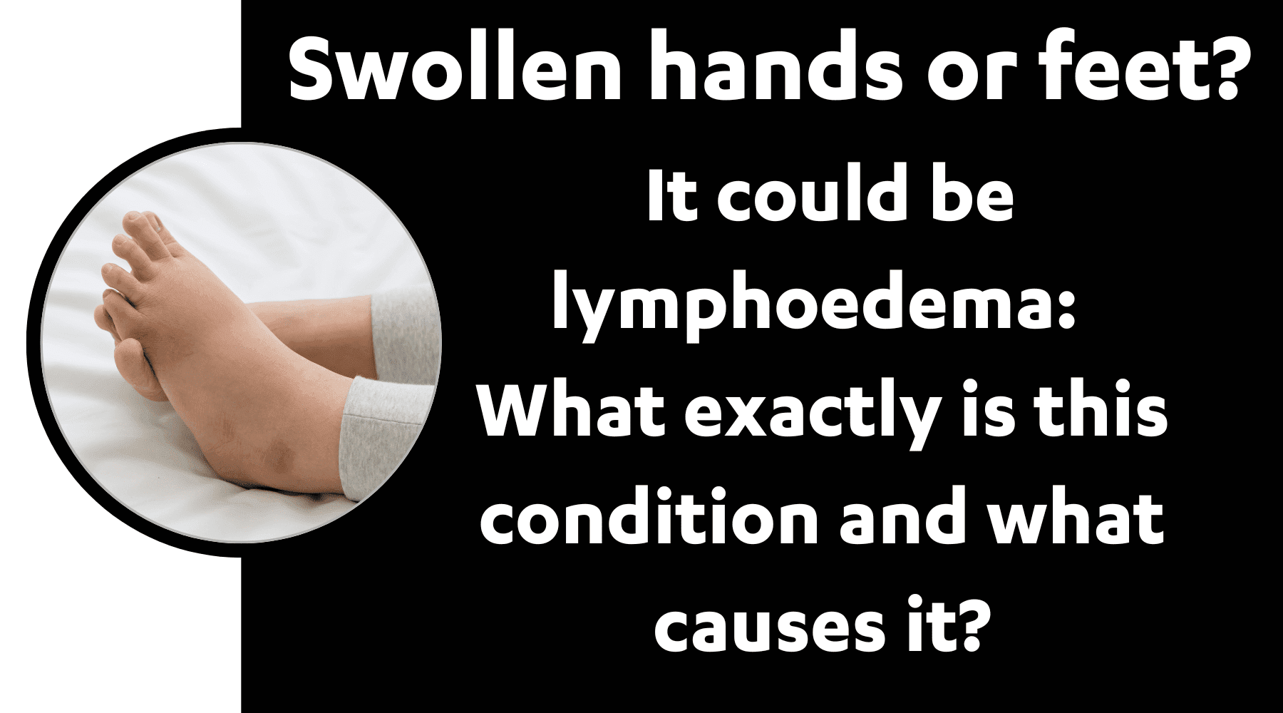 Swollen hands or legs? It could be Lymphoedema: What exactly is this condition and what causes it? - Dr Kez Chirolab